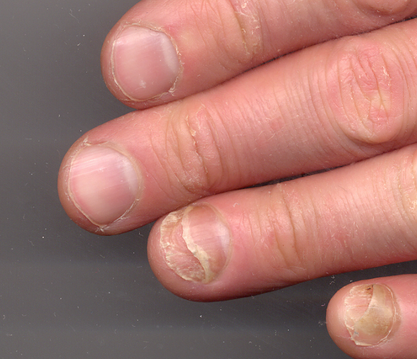 nail-clinic-onycholysis-what-it-looks-like-causes-and-treatment